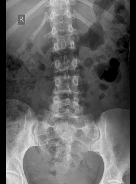 Scoliosis Xray